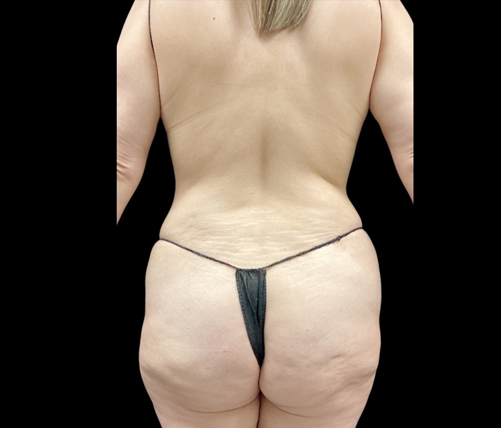 Liposuction Before & After Gallery - Patient 155293 - Image 5