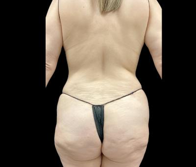 Liposuction Before & After Gallery - Patient 155293 - Image 5