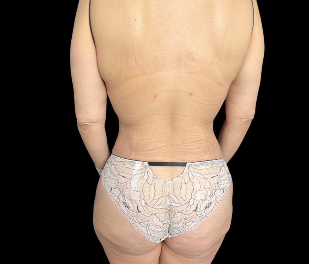 Liposuction Before & After Gallery - Patient 155293 - Image 6