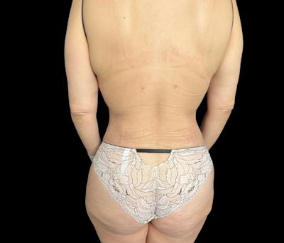 Liposuction Before & After Gallery - Patient 155293 - Image 6