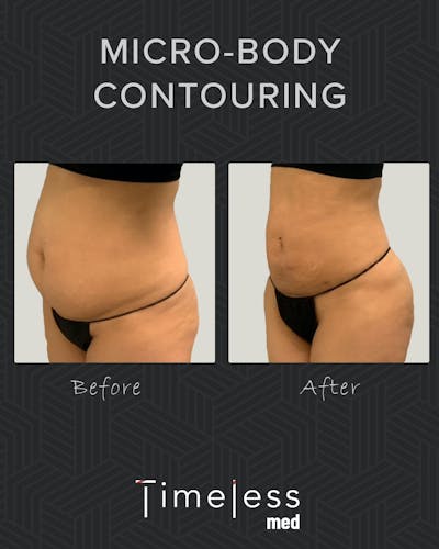 Body Before & After Gallery - Patient 34169873 - Image 1