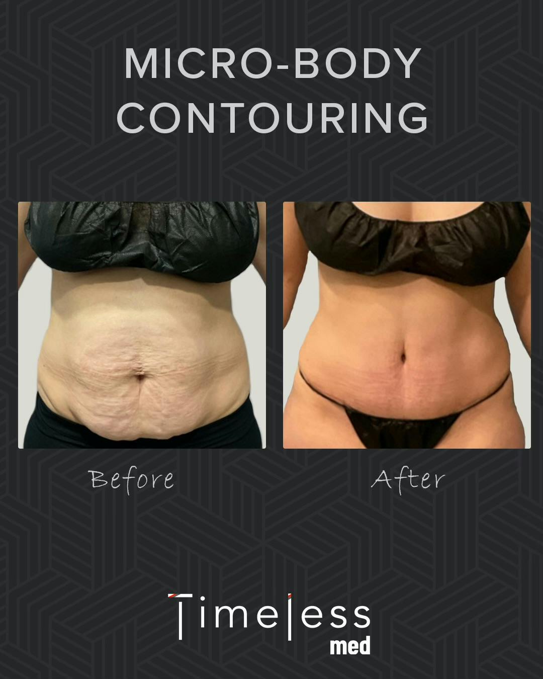 Body Before & After Gallery - Patient 34169874 - Image 1