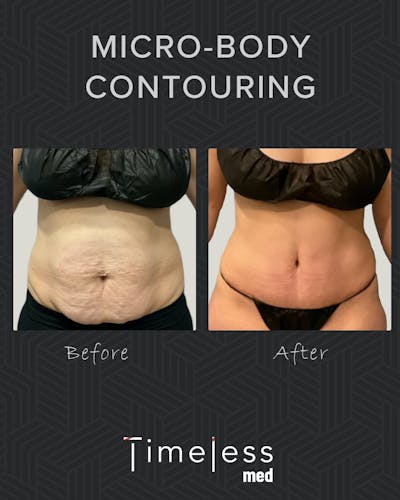Body Before & After Gallery - Patient 34169874 - Image 1