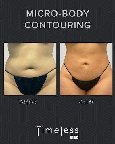 Body Before & After Gallery - Patient 34176949 - Image 1