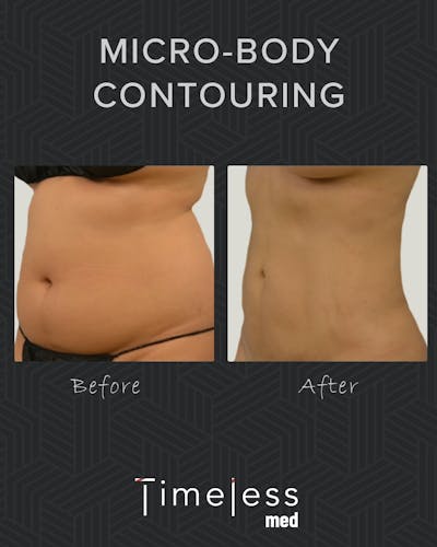 Body Before & After Gallery - Patient 34176950 - Image 1