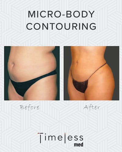 Body Before & After Gallery - Patient 34176951 - Image 1