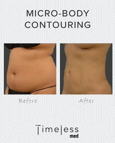 Body Before & After Gallery - Patient 34176952 - Image 1