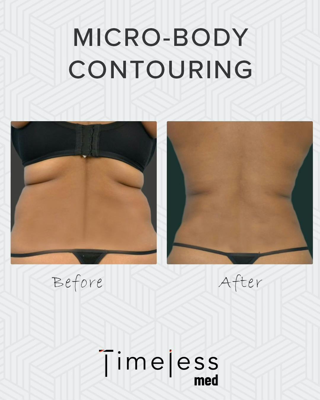 Body Before & After Gallery - Patient 34176953 - Image 1
