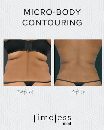 Body Before & After Gallery - Patient 34176953 - Image 1