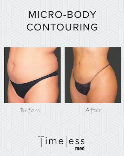 Body Before & After Gallery - Patient 34176954 - Image 1
