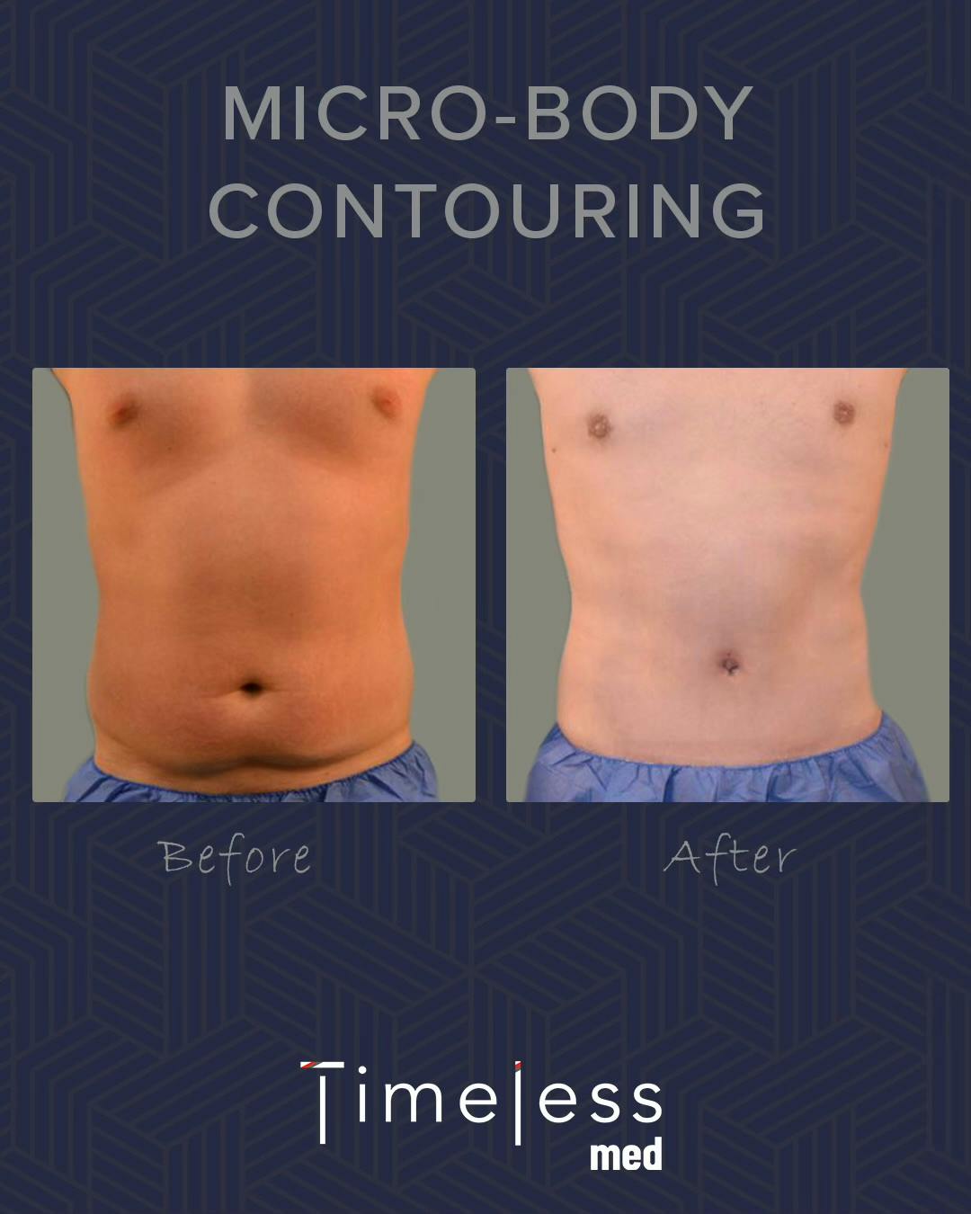 Body Before & After Gallery - Patient 34176955 - Image 1