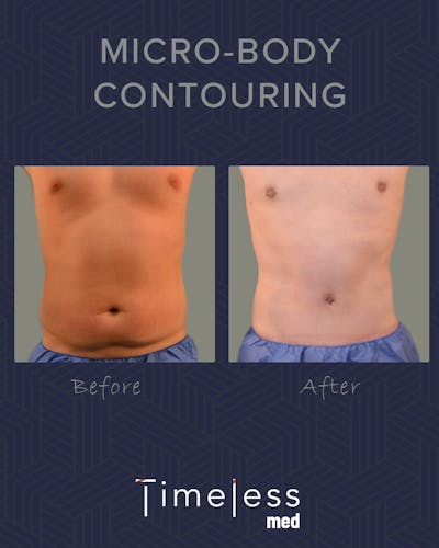 Body Before & After Gallery - Patient 34176955 - Image 1