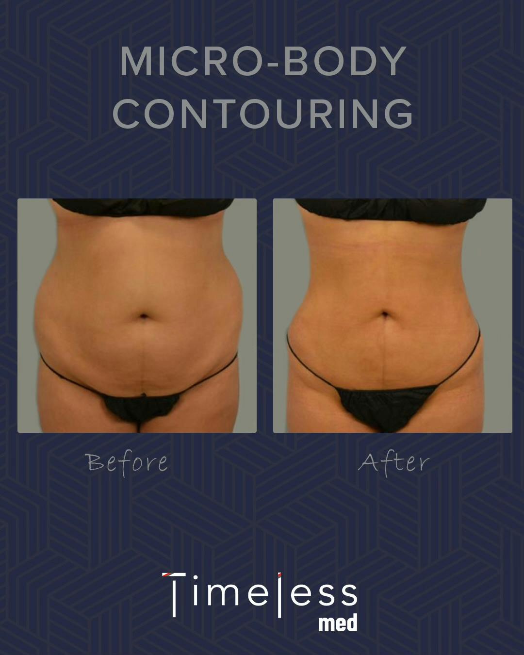Body Before & After Gallery - Patient 34176956 - Image 1