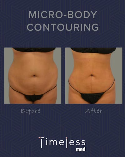 Body Before & After Gallery - Patient 34176956 - Image 1
