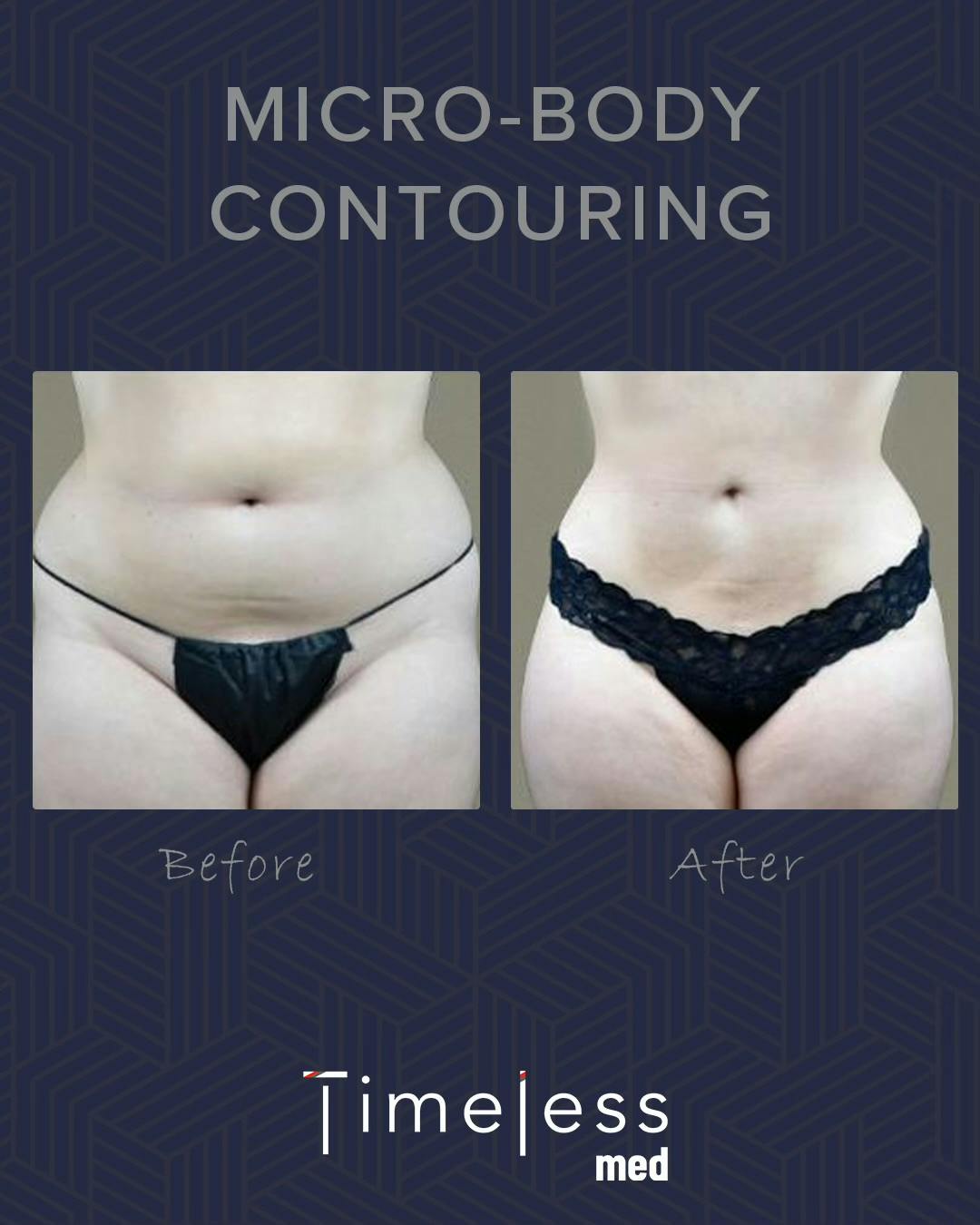 Body Before & After Gallery - Patient 34177564 - Image 1