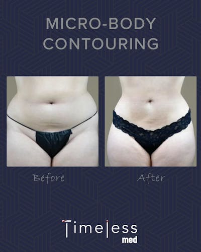 Body Before & After Gallery - Patient 34177564 - Image 1