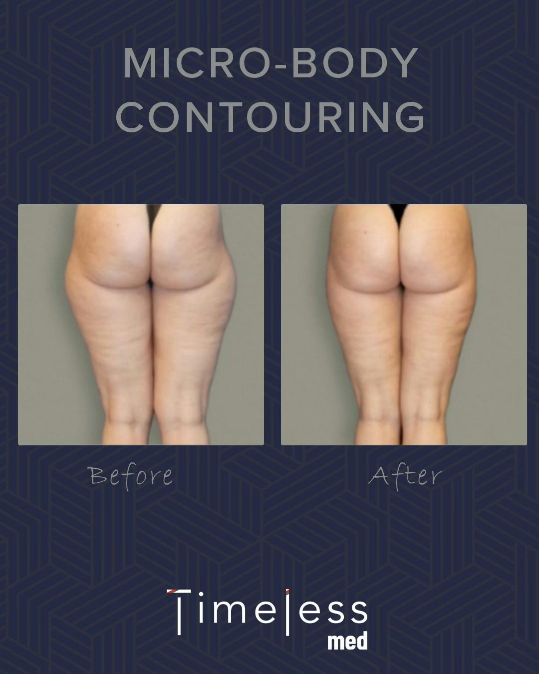 Body Before & After Gallery - Patient 34177565 - Image 1