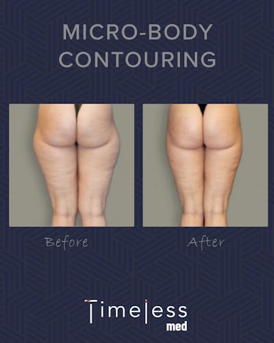 Body Before & After Gallery - Patient 34177565 - Image 1