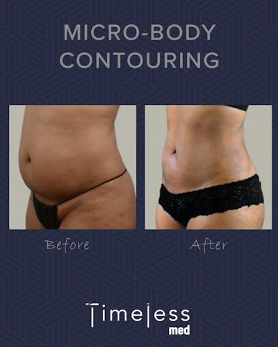 Body Before & After Gallery - Patient 34177566 - Image 1