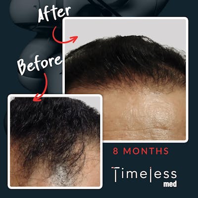 Hair Before & After Gallery - Patient 36412324 - Image 1