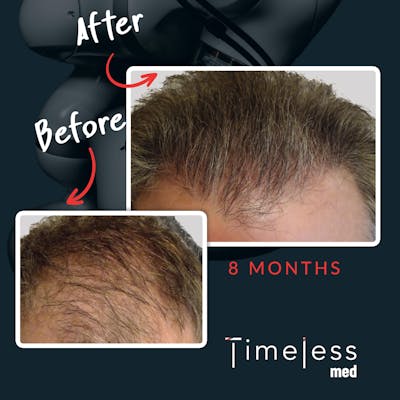 Hair Before & After Gallery - Patient 36412325 - Image 1