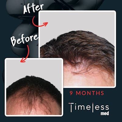 Hair Before & After Gallery - Patient 36412326 - Image 1
