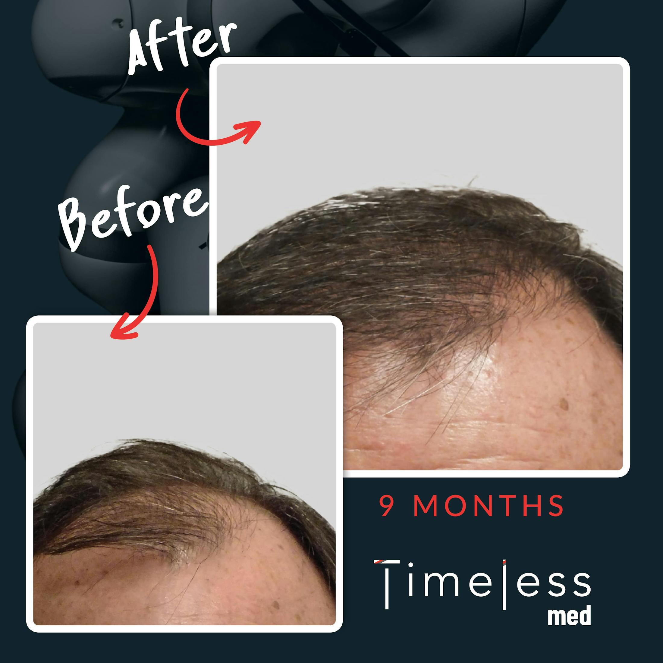 Hair Before & After Gallery - Patient 36412327 - Image 1