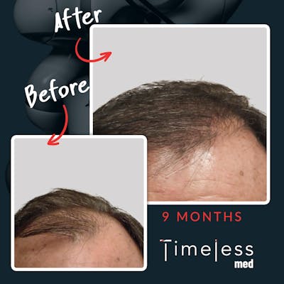 Hair Before & After Gallery - Patient 36412327 - Image 1