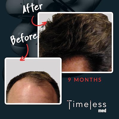 Hair Before & After Gallery - Patient 36412328 - Image 1
