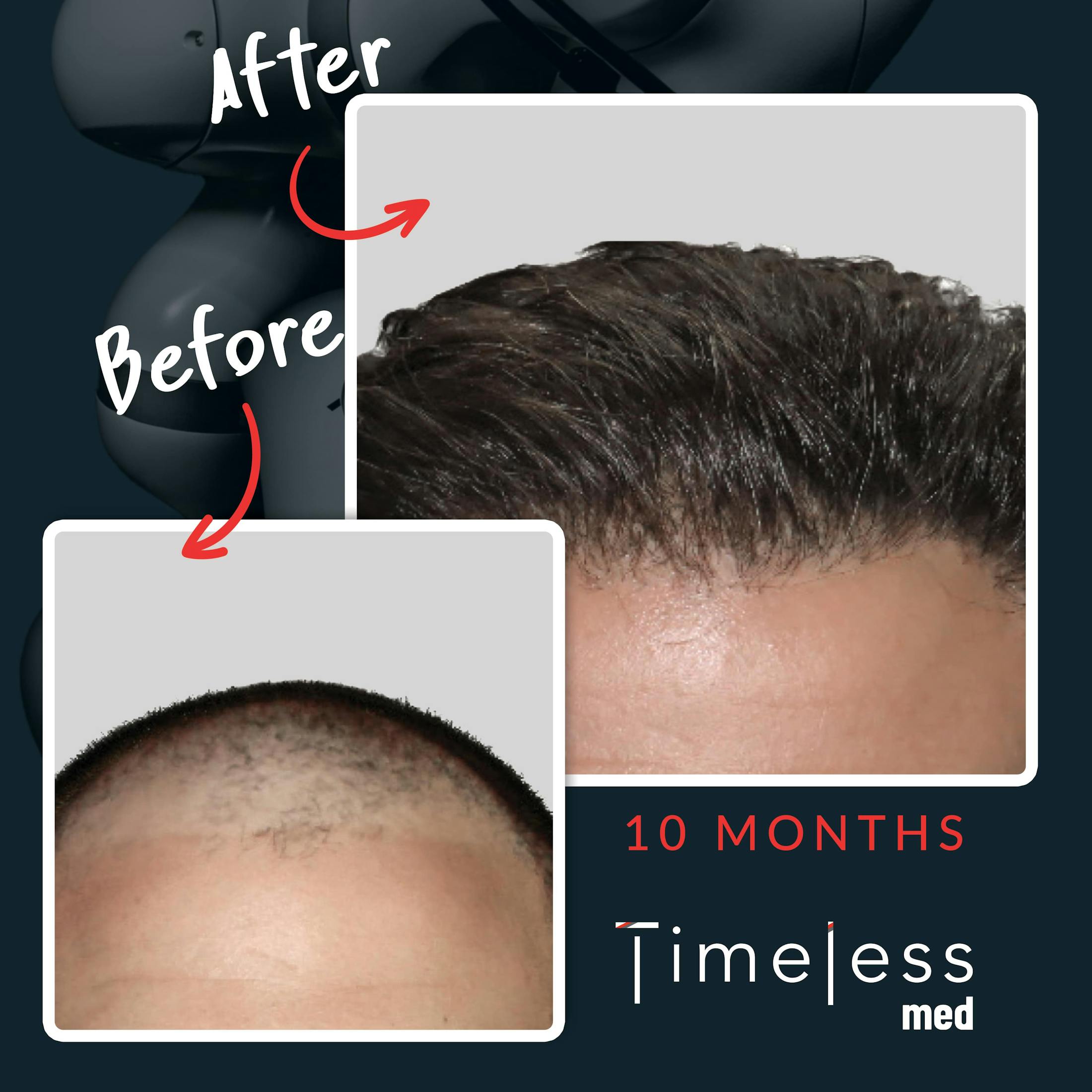 Hair Before & After Gallery - Patient 36412329 - Image 1