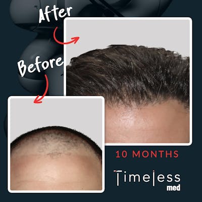 Hair Before & After Gallery - Patient 36412329 - Image 1