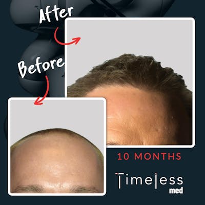 Hair Before & After Gallery - Patient 36412330 - Image 1