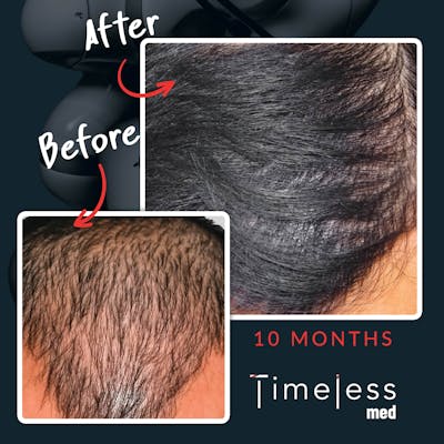 Hair Before & After Gallery - Patient 36412332 - Image 1