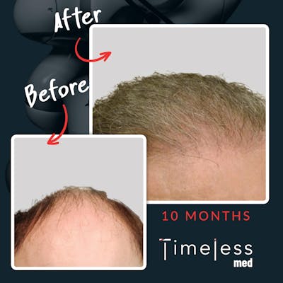 Hair Before & After Gallery - Patient 36412333 - Image 1