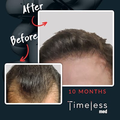 Hair Before & After Gallery - Patient 36412334 - Image 1