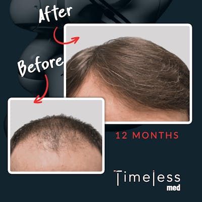 Hair Before & After Gallery - Patient 36412335 - Image 1