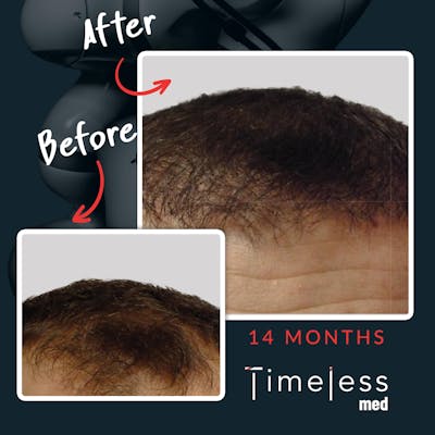 Hair Before & After Gallery - Patient 36412336 - Image 1