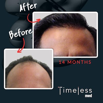 Hair Before & After Gallery - Patient 36412337 - Image 1