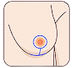 Graphic of Full Lift (Mastopexy)