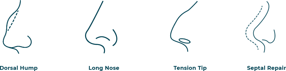 Infographic of Different Types of Noses
