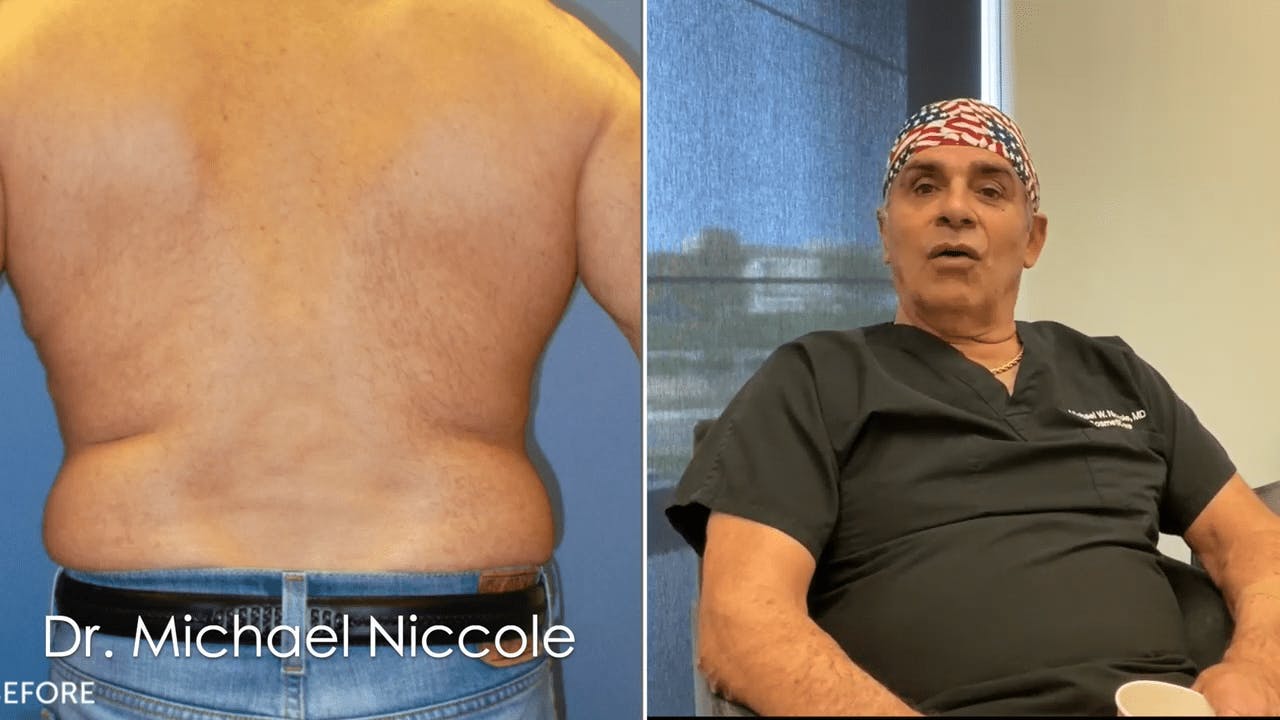 Dr. Discussing Liposuction with a Before Picture on the Left