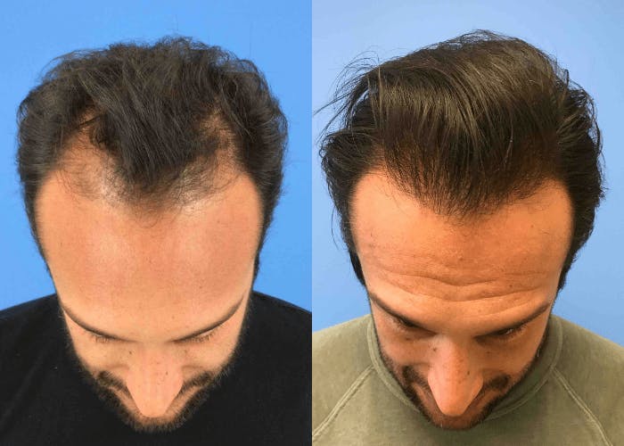 5 Things You Need to Know About Hair Restoration at CosmetiCare in Newport Beach