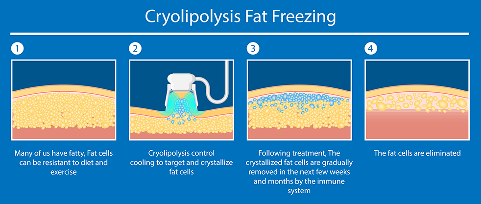 Fat Freezing Infographic