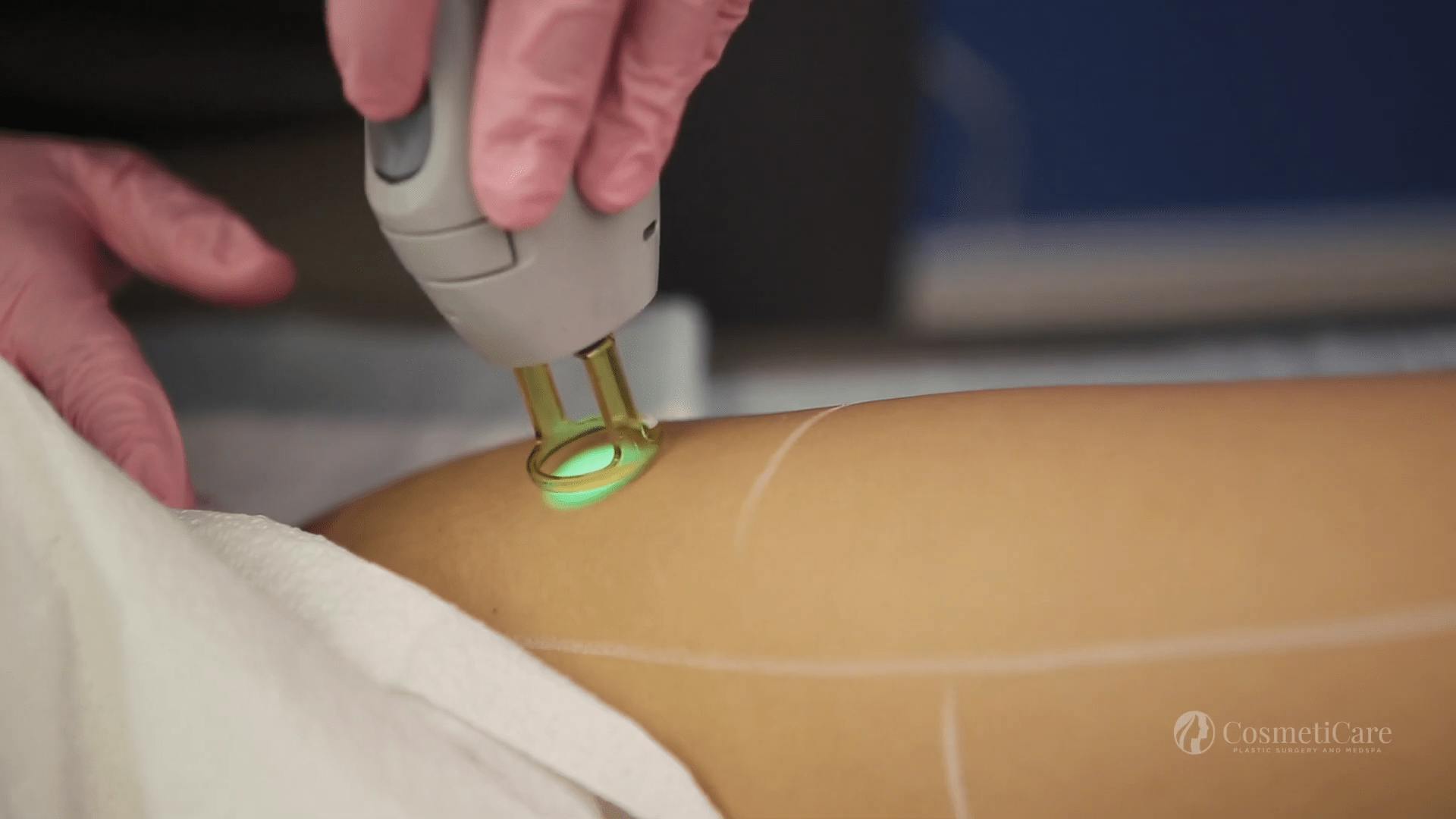 Closeup of Laser Hair Removal