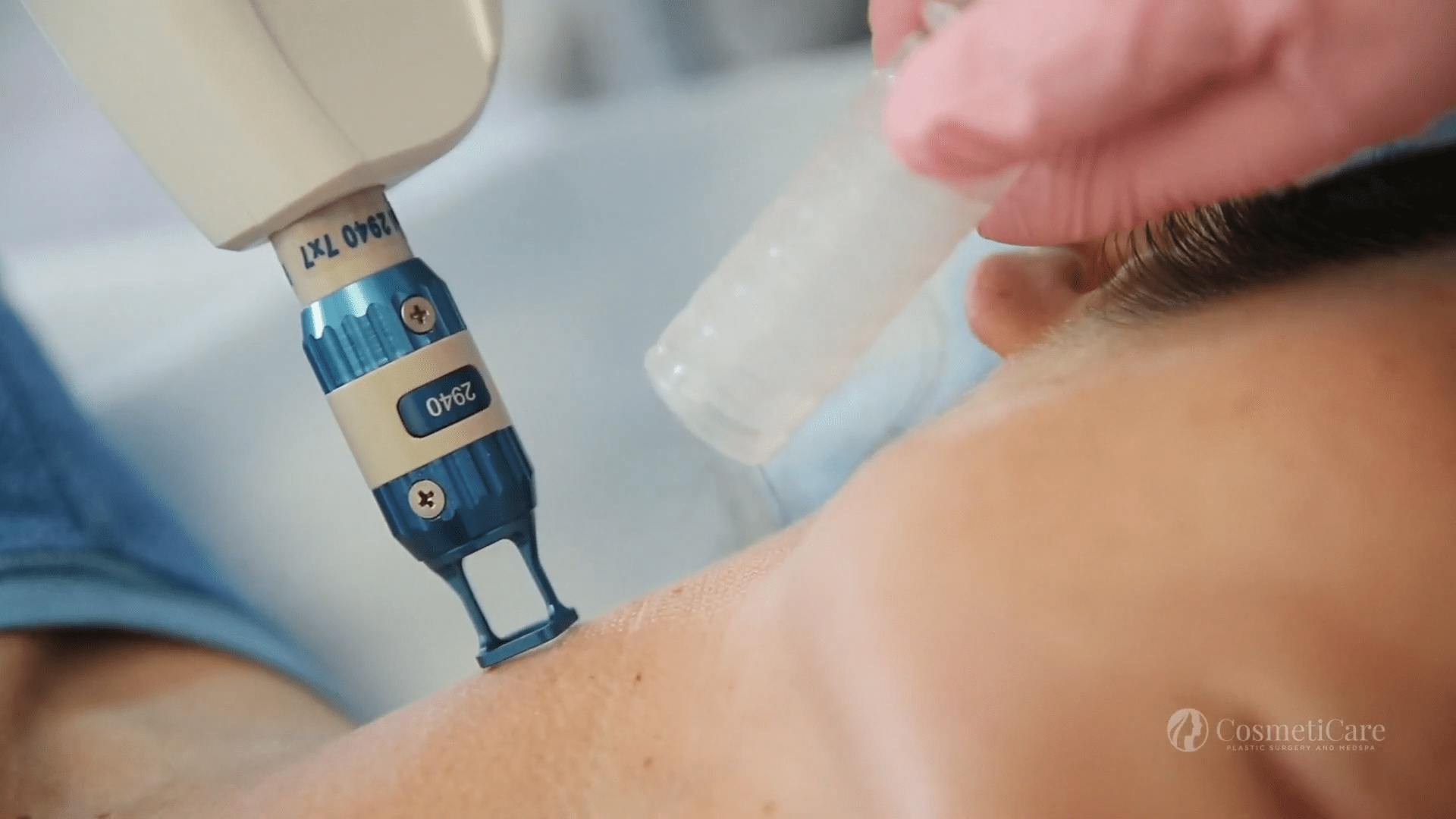 Close up of Erbium Laser Treatment