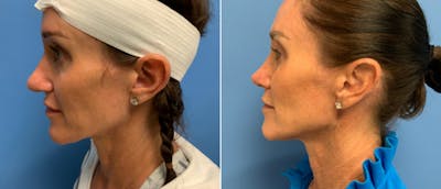 Rhinoplasty Before & After Gallery - Patient 38564638 - Image 1