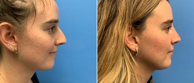 Rhinoplasty Before & After Gallery - Patient 38564639 - Image 1