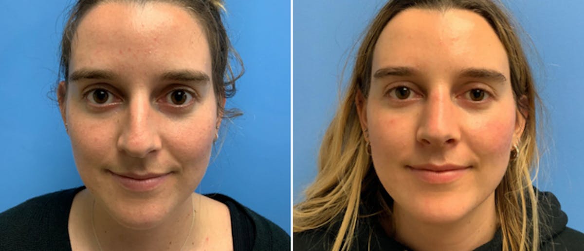 Rhinoplasty Before & After Gallery - Patient 38564639 - Image 2