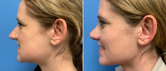 Rhinoplasty Before & After Gallery - Patient 38564642 - Image 1