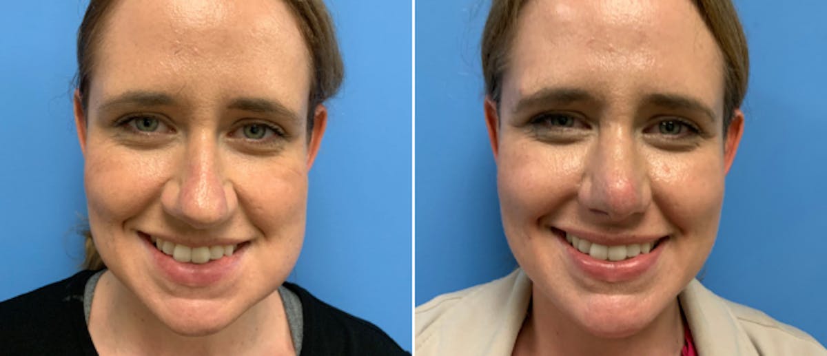 Rhinoplasty Before & After Gallery - Patient 38564642 - Image 2